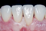 Veneers, Verblendschalen